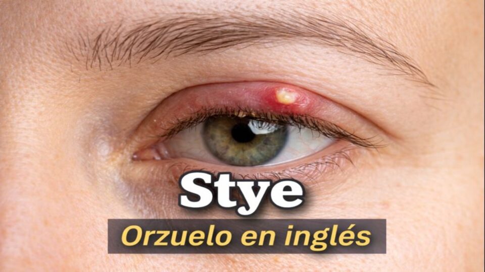 Orzuelo en Inglés